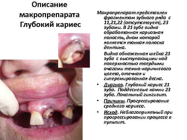   Описание макропрепарата  Макропрепарат представлен     фрагментом зубного ряда