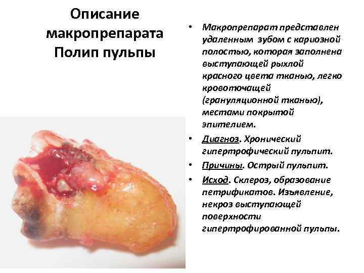   Описание    • Макропрепарат представлен макропрепарата удаленным зубом с кариозной