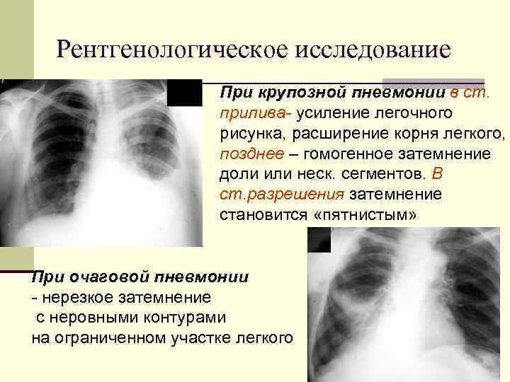 Признаки пневмонии на рентгене