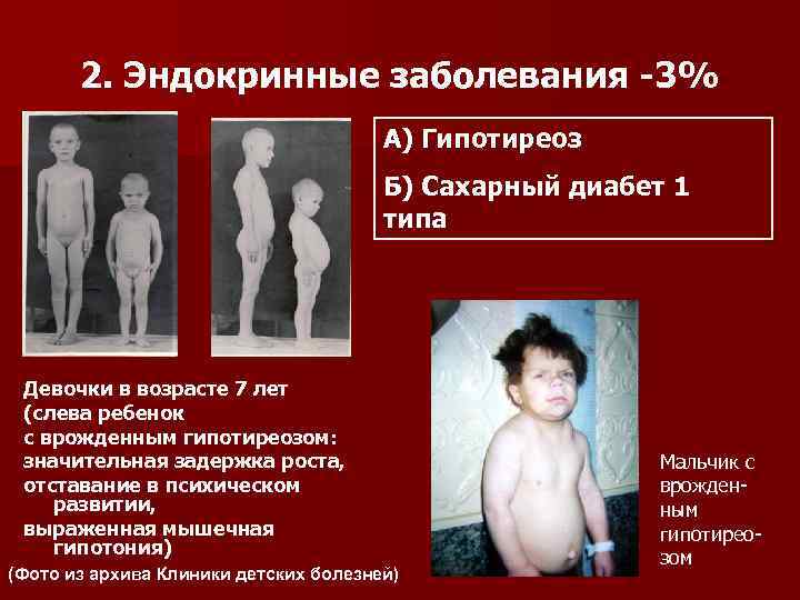   2. Эндокринные заболевания -3%    А) Гипотиреоз   