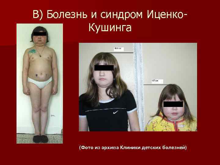 В) Болезнь и синдром Иценко-  Кушинга   (Фото из архива Клиники детских
