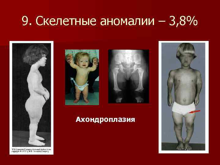 9. Скелетные аномалии – 3, 8%   Ахондроплазия 