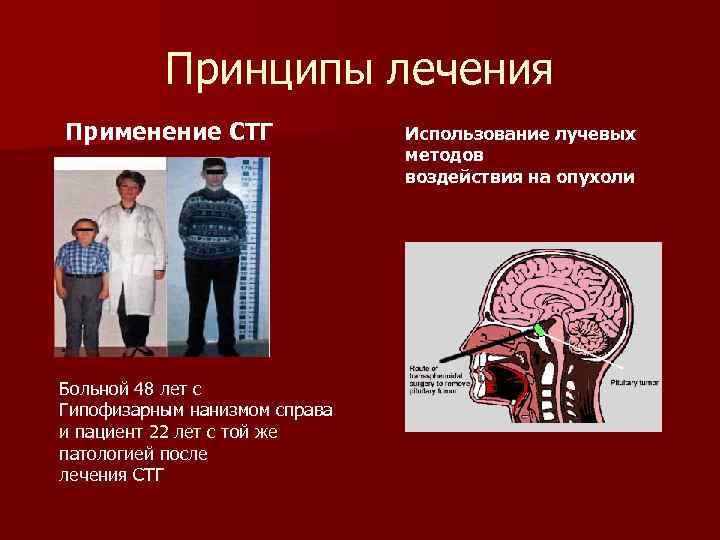    Принципы лечения Применение СТГ   Использование лучевых   