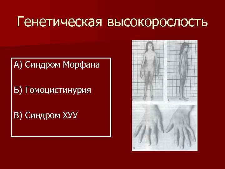 Генетическая высокорослость  А) Синдром Морфана Б) Гомоцистинурия В) Синдром ХУУ 