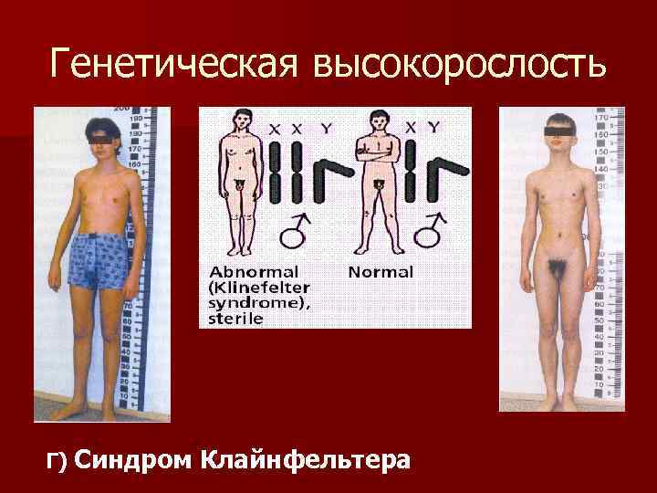 Генетическая высокорослость Г) Синдром Клайнфельтера 