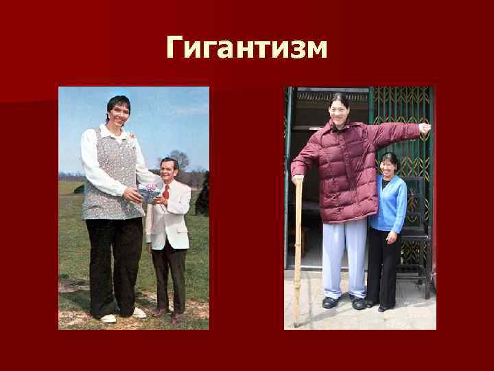 Гигантизм у детей фото