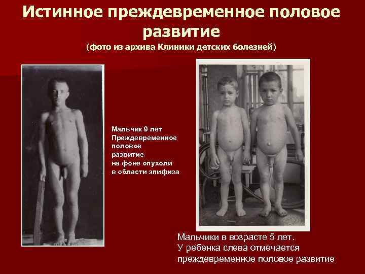 Истинное преждевременное половое   развитие  (фото из архива Клиники детских болезней) 