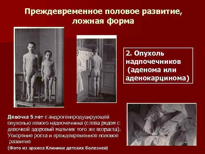  Преждевременное половое развитие,   ложная форма     2. Опухоль