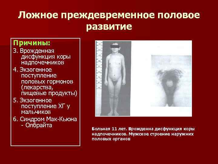  Ложное преждевременное половое   развитие Причины: 3. Врожденная  дисфункция коры 