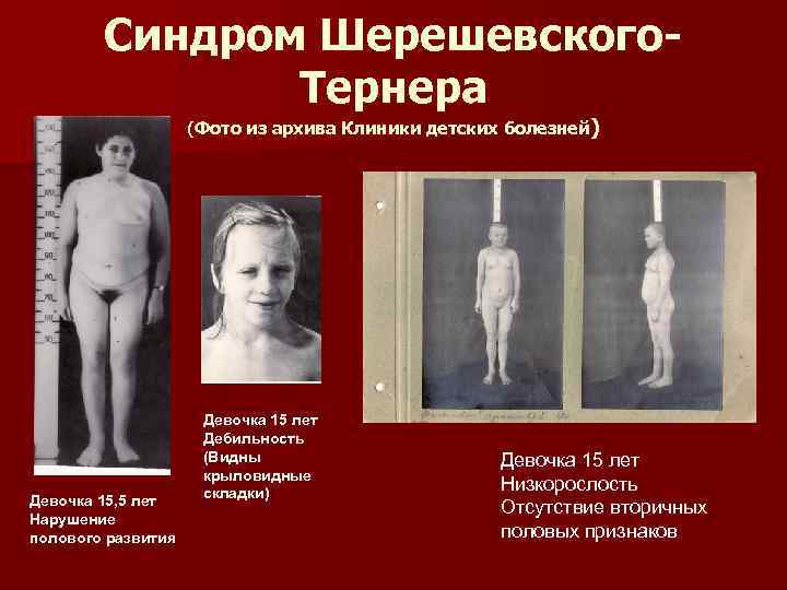   Синдром Шерешевского-    Тернера     (Фото из