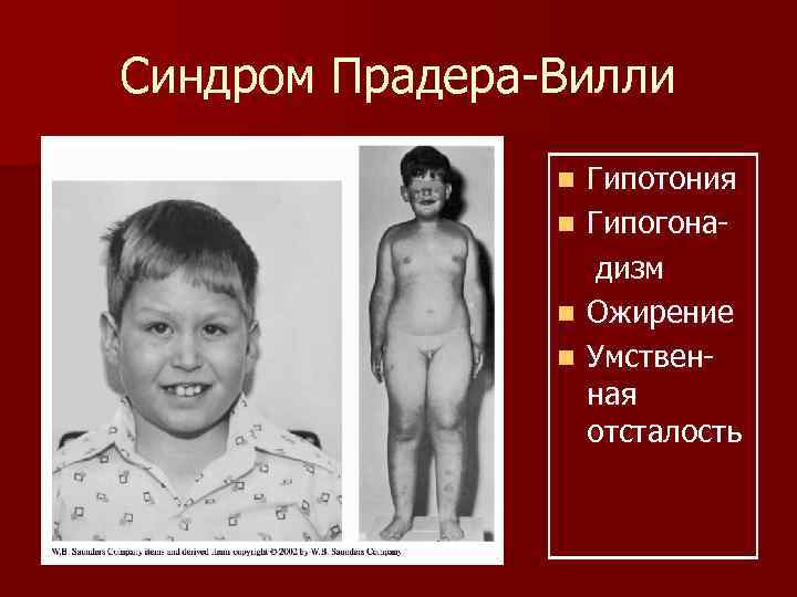 Синдром Прадера-Вилли   n  Гипотония   n  Гипогона-  