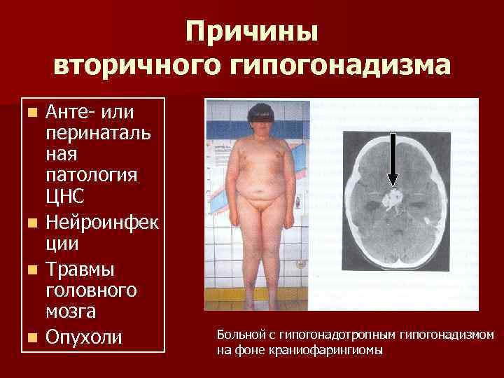   Причины вторичного гипогонадизма n  Анте- или перинаталь ная патология ЦНС n