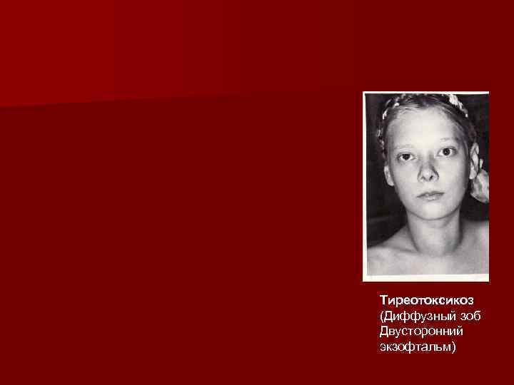 Тиреотоксикоз (Диффузный зоб Двусторонний экзофтальм) 