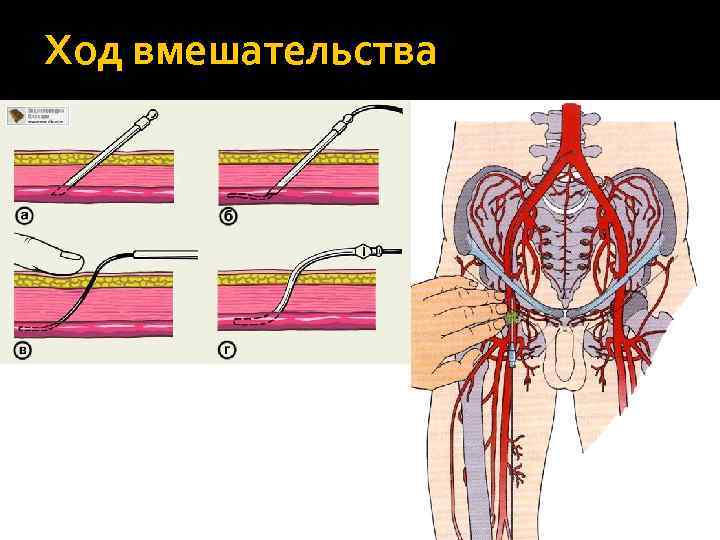 Ход вмешательства 