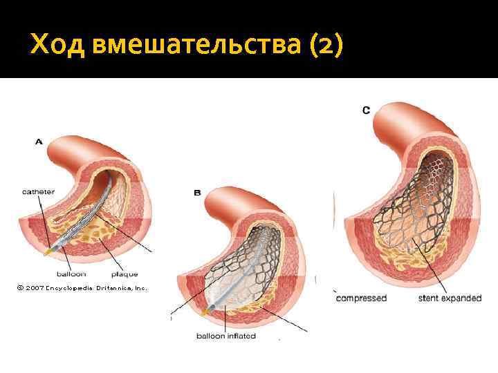 Ход вмешательства (2) 
