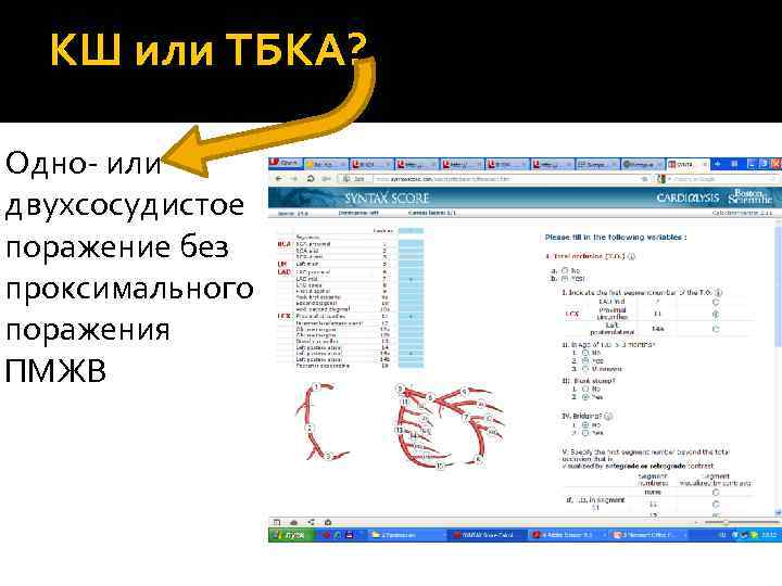  КШ или ТБКА?  Одно- или двухсосудистое поражение без проксимального поражения ПМЖВ 