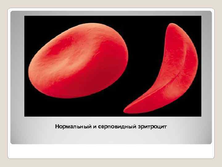 Серповидноклеточная анемия какая. Серповидная анемия эритроциты. Клеточная анемия серповидноклеточная. Серповидноклеточная анемия симптомы. Серповидно-клеточная анемия (s-гемоглобинопатия).