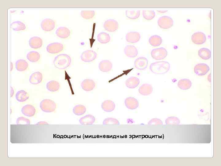 Кодоциты (мишеневидные эритроциты) 