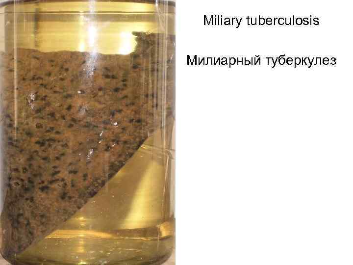  Miliary tuberculosis Милиарный туберкулез 