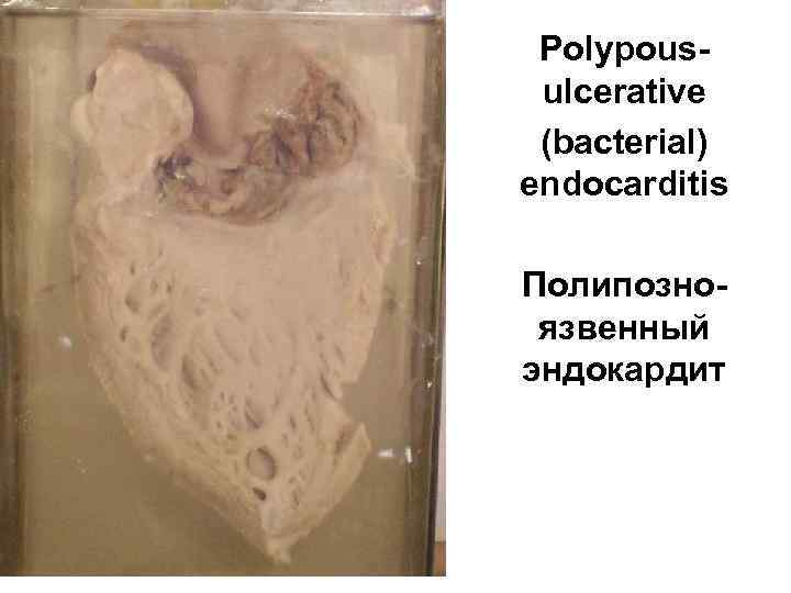  Polypous- ulcerative (bacterial) endocarditis Полипозно- язвенный эндокардит 