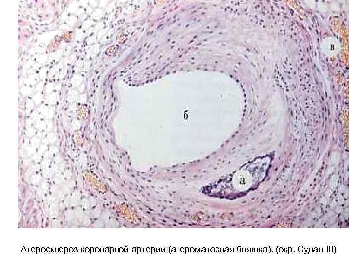 Атеросклероз коронарной артерии (атероматозная бляшка). (окр. Судан ІІІ) 