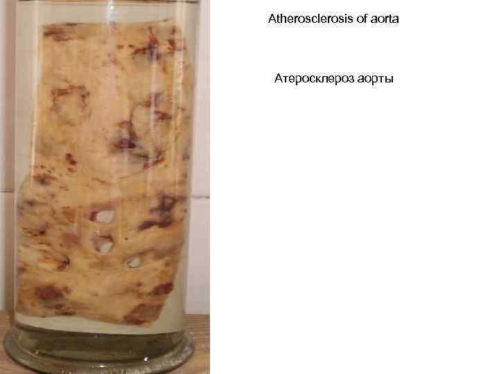 Atherosclerosis of aorta Атеросклероз аорты 