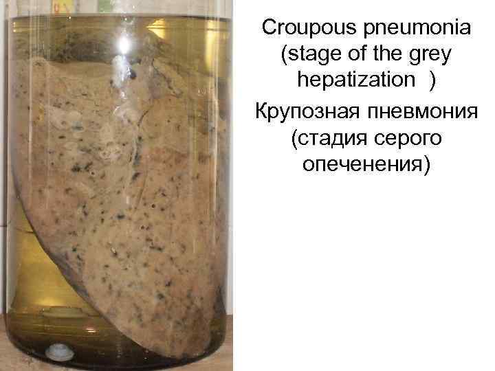  Croupous pneumonia  (stage of the grey hepatization ) Крупозная пневмония (стадия серого