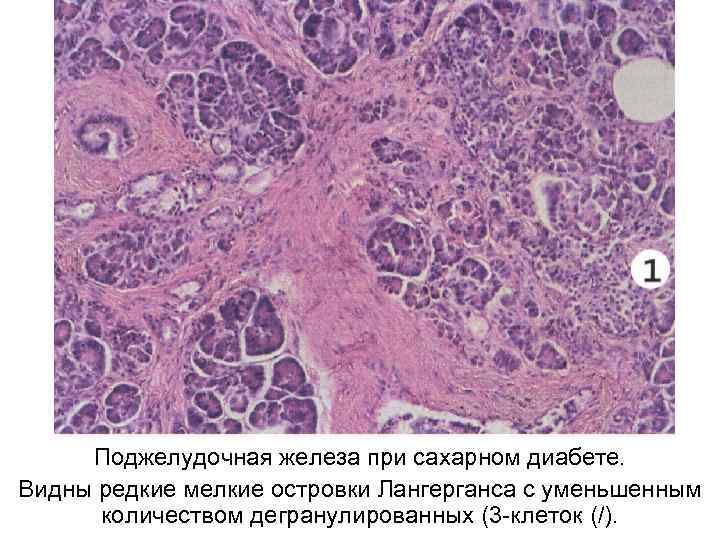  Поджелудочная железа при сахарном диабете. Видны редкие мелкие островки Лангерганса с уменьшенным 
