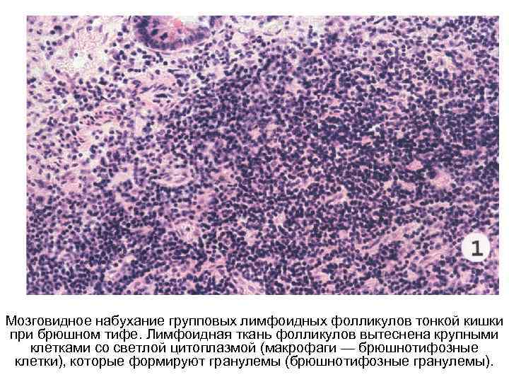 Мозговидное набухание групповых лимфоидных фолликулов тонкой кишки при брюшном тифе. Лимфоидная ткань фолликулов вытеснена
