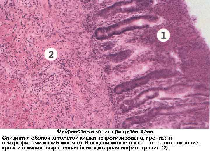    Фибринозный колит при дизентерии. Слизистая оболочка толстой кишки некротизирована, пронизана нейтрофилами