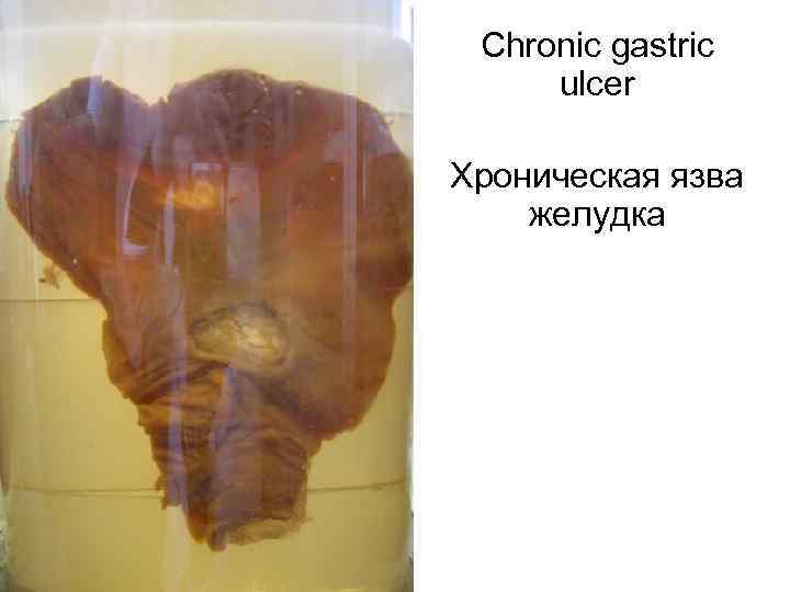  Chronic gastric ulcer Хроническая язва желудка 