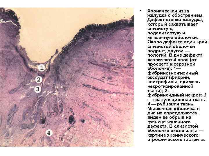  •  Хроническая язва желудка с обострением. Дефект стенки желудка, который захватывает слизистую,