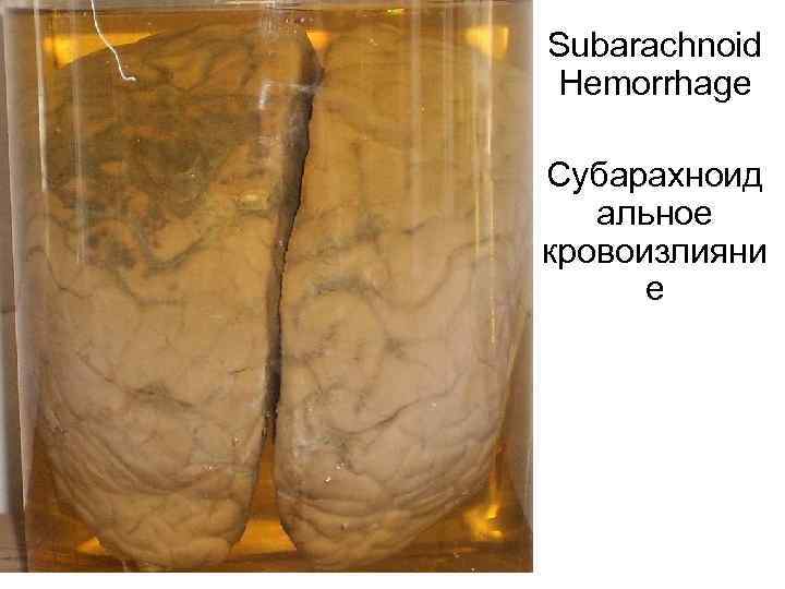 Subarachnoid Hemorrhage Субарахноид  альное кровоизлияни  е 