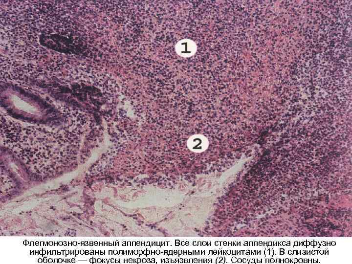 Флегмонозно-язвенный аппендицит. Все слои стенки аппендикса диффузно инфильтрированы полиморфно-ядерными лейкоцитами (1). В слизистой 
