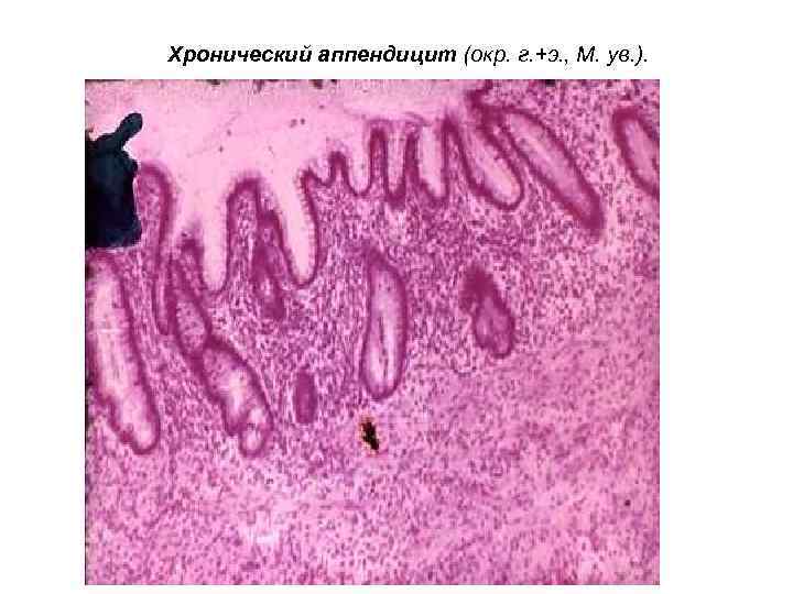 Хронический аппендицит (окр. г. +э. , М. ув. ). 