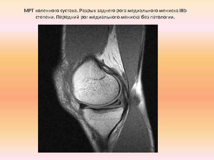 МРТ коленного сустава. Разрыв заднего рога медиального мениска IIIb степени. Передний рог медиального мениска