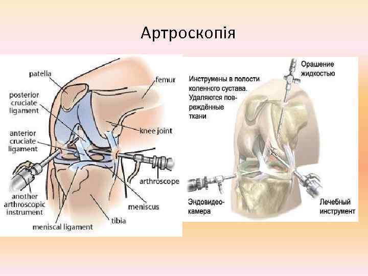 Артроскопія 