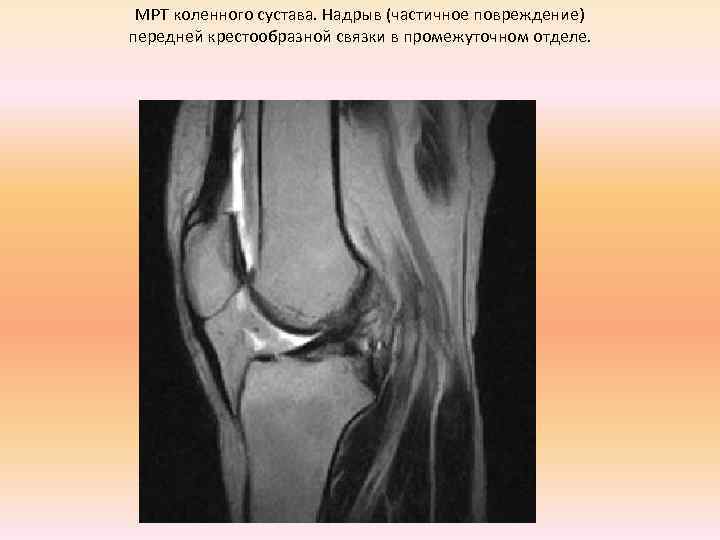  МРТ коленного сустава. Надрыв (частичное повреждение) передней крестообразной связки в промежуточном отделе. 