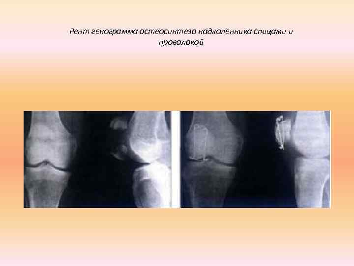 Рент генограмма остеосинтеза надколенника спицами и     проволокой 