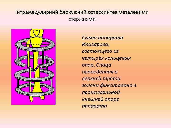 Інтрамедулярний блокуючий остеосинтез металевими    стержнями     Схема аппарата