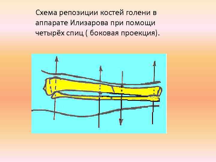 Схема репозиции костей голени в аппарате Илизарова при помощи четырёх спиц ( боковая проекция).