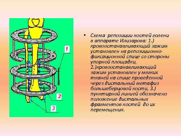  • Схема репозиции костей голени  в аппарате Илизарова: 1. )  кровоостанавливающий