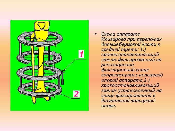  • Схема аппарате  Илизарова при переломах  большеберцовой кости в  средней