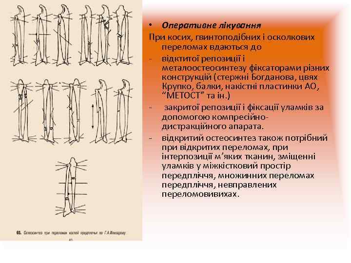  • Оперативне лікування При косих, гвинтоподібних і осколкових  переломах вдаються до -