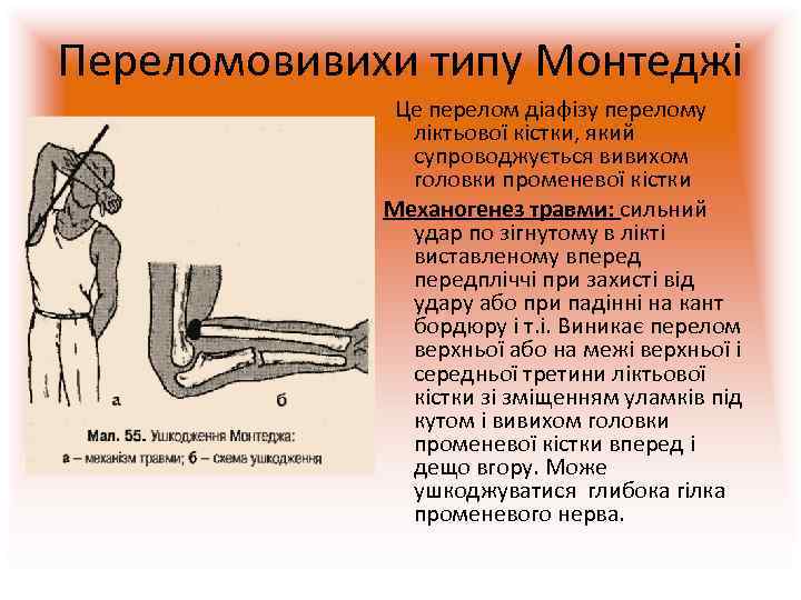 Переломовивихи типу Монтеджі    Це перелом діафізу перелому   ліктьової кістки,