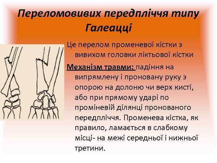 Переломовивих передпліччя типу  Галеацці   Це перелом променевої кістки з  вивихом