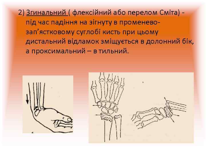 2) Згинальний ( флексійний або перелом Сміта) - під час падіння на зігнуту в