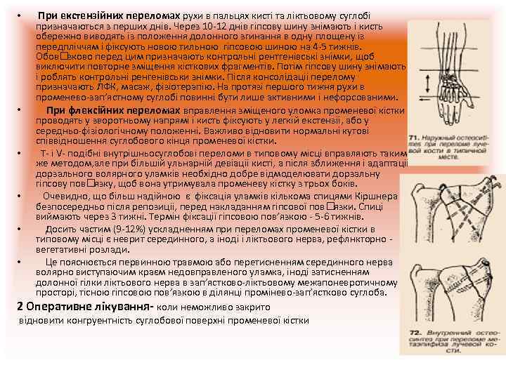  • При екстензійних переломах рухи в пальцях кисті та ліктьовому суглобі  призначаються