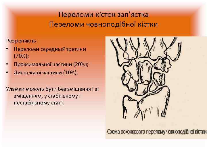    Переломи кісток зап’ястка   Переломи човноподібної кістки Розрізняють:  •