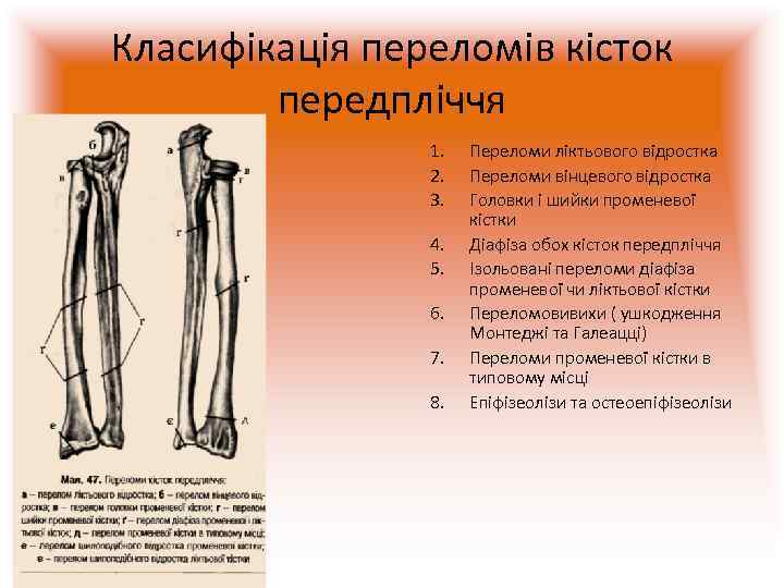 Класифікація переломів кісток   передпліччя   1.  Переломи ліктьового відростка 